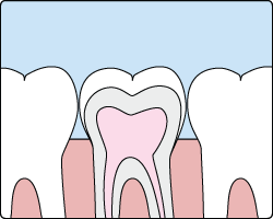 Sealants protect hard-to-reach spots on teeth
